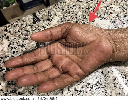 Thenar Muscle Wasting. Atrophy At The Thumb Base Of Asian Elderly Woman.