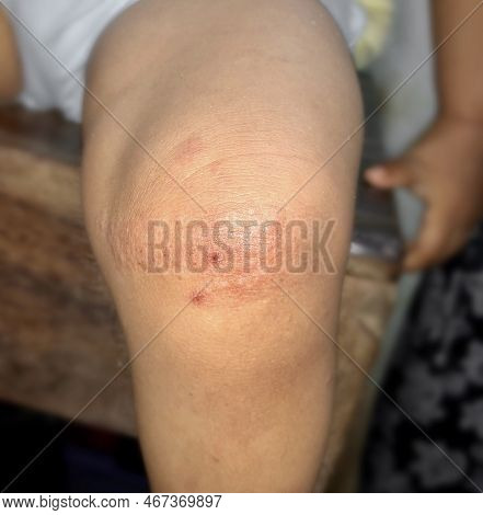 Fungal Infection Called Tinea Corporis In Leg Of Asian Child. Widespread Ringworm Over Knee Area.