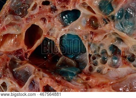 Close-up Of A Gross Specimen Of A Human Kidney In A Case Of Autosomal Dominant Polycystic Kidney Dis