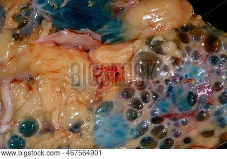 Close-up Of A Gross Specimen Showing The Surface Of A Human Kidney In A Case Of Autosomal Dominant P