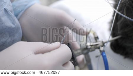 Opened Endoscopic Basket For Removing Stones From Organs. The Doctor Holds Endoscopic Equipment In H