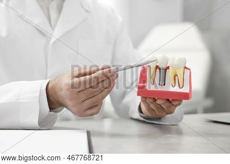 Doctor Showing Educational Model Of Dental Implant In Clinic, Closeup