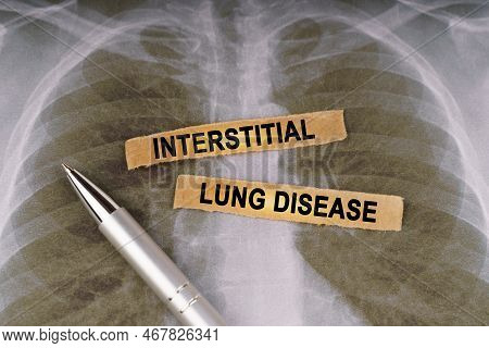 Medical Concept. On A Human Chest X-ray, A Pen And Strips Of Paper Labeled - Interstitial Lung Disea