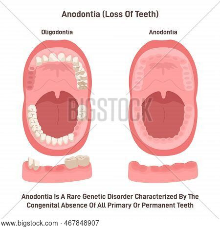 Anodontia. Rare Genetic Disorder Characterized By The Congenital