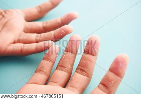 Close Up Of Dry Cracked Skin Of A Mens Hand