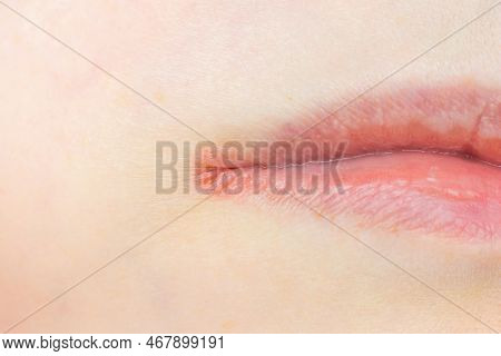 Woman Lips Skin With Herpes Labialis Virus Close Up.