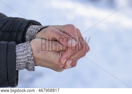 Women's Frozen Hands In The Cold.women's Hands With Dry Skin And Red Fingers In The Cold In Winter.t