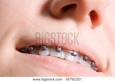 young girl smiling with braces on teeth