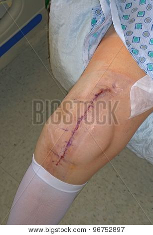 Knee Replacement Surgery Scar