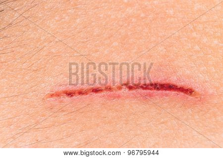 Very close up of painful wound on forehead from deep cut