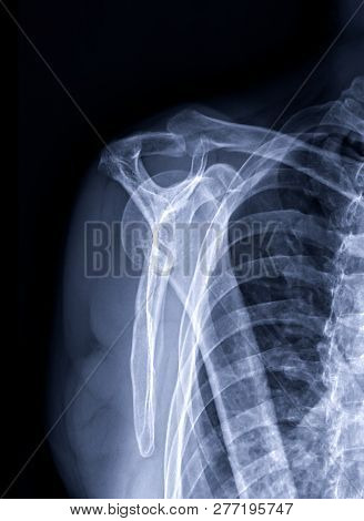 Radiographic Image Or X-ray Image Of Shoulder Joint. Additional View Name Is Supraspinatus Outlet