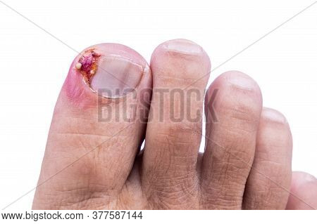 Closeup Of Inflammation And Blood Associated With Ingrown Toenail