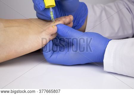 The Doctor Dermatologist Drops The Medicine With A Pipette On The Nail Affected By The Fungus. Antim