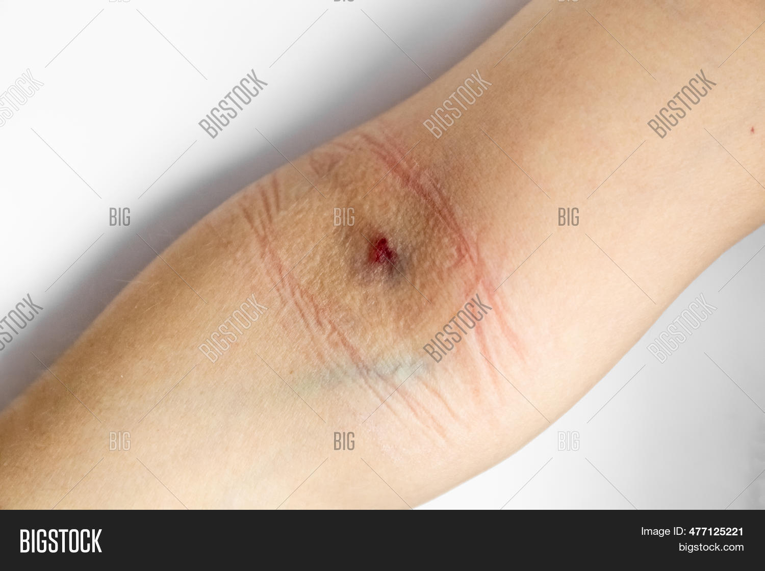 Bruise Needle On Arm. Image & Photo (Free Trial) Bigstock