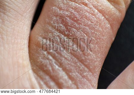 Hand Dermatitis. Hand Eczema Closed On Black Background