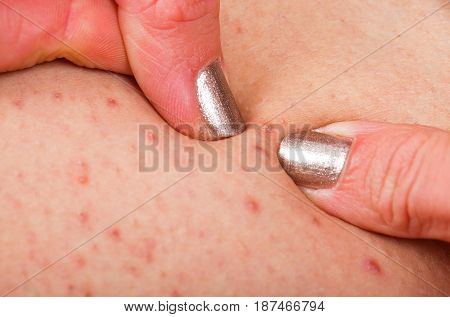 Close up picture of folliculitis on human skin woman fingers popping it out