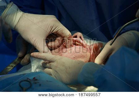 Surgeon puts finger into patients mouth during the maxillofacial surgery close up