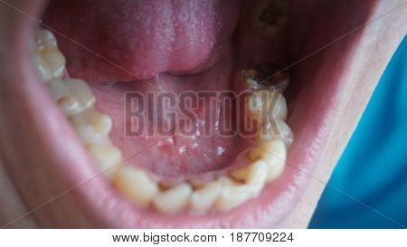 Bad teeth of a guy. Rotten and yellow teeth. Caries