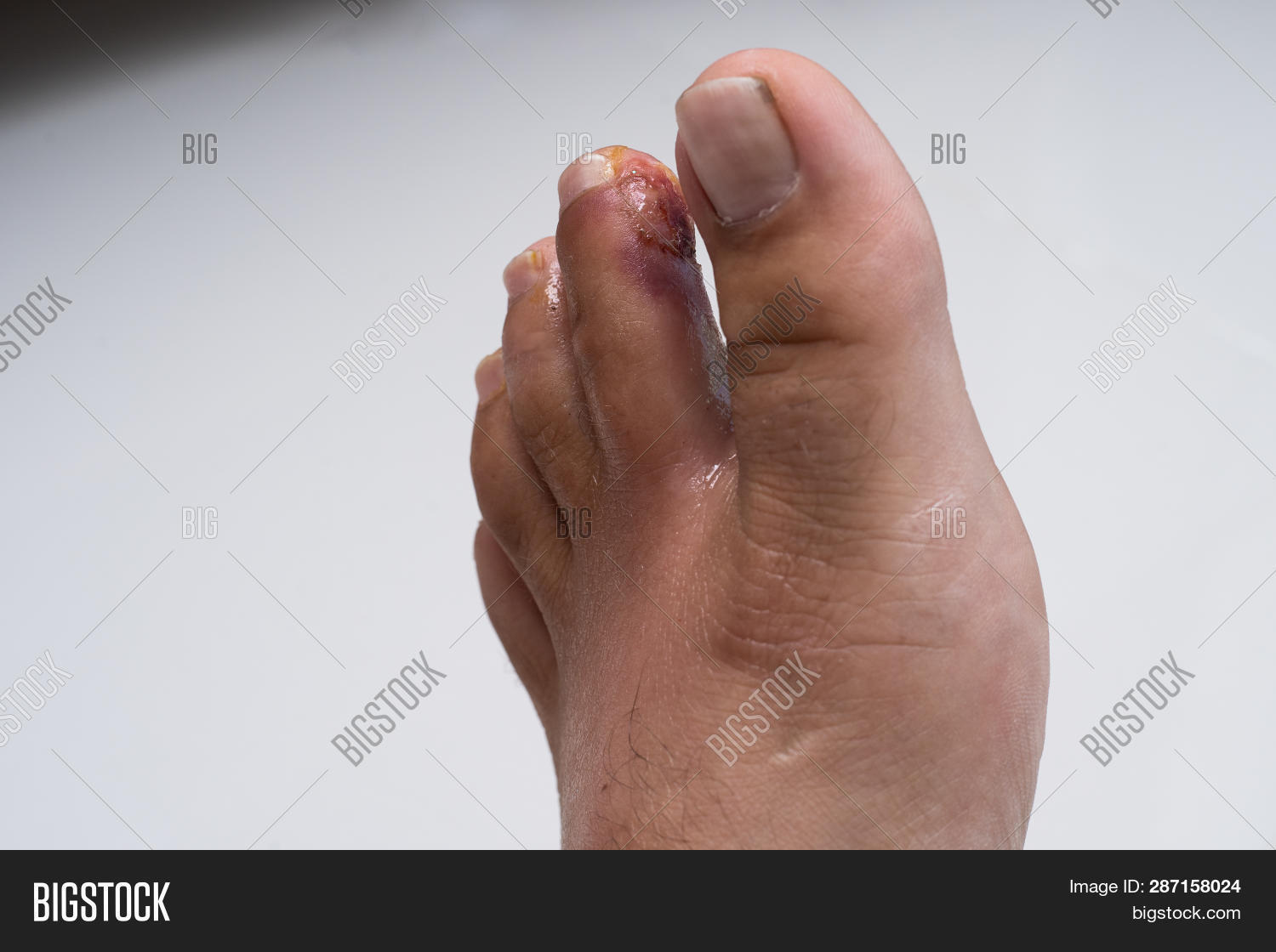 Finger On Leg. Image & Photo (Free Trial) Bigstock