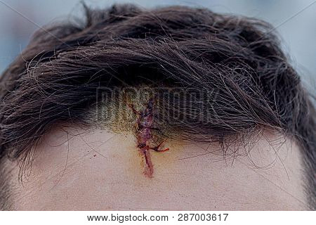Suture Wound At Skull With Wires, Postoperative Stitching Craniectomy With Many Staples, Medical Sew