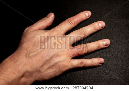 Hand Dermatitis. Hand Eczema Closed On Black Background