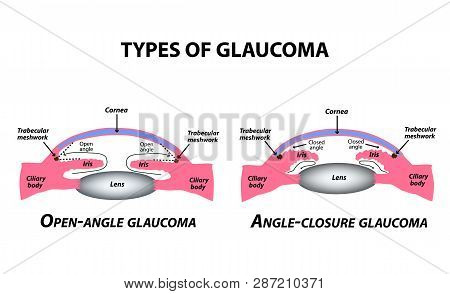Types Of Glaucoma. Open-angle And Angle-closure Glaucoma. The Anatomical Structure Of The Eye. Infog