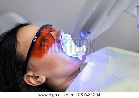 Laser Bleaching Teeth At Dantist Room. Teeth Whitening For Woman. Bleaching Of The Teeth At Dentist