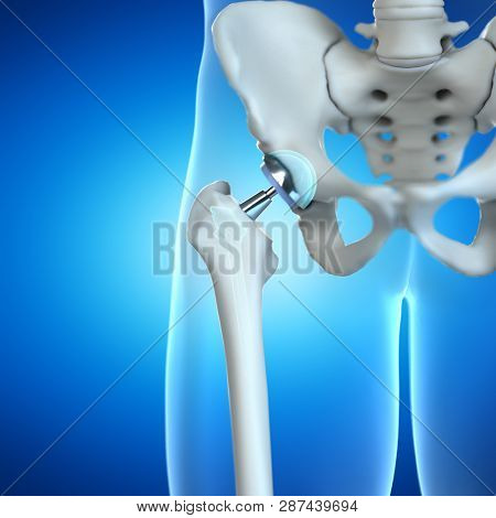 3d rendered illustration of a hip implant
