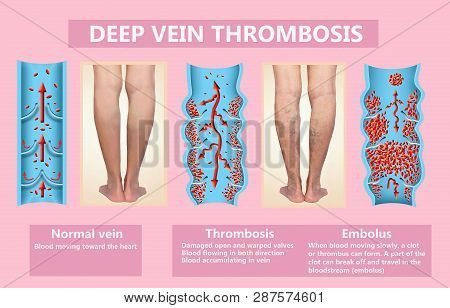 Deep Vein Thrombosis Or Blood Clots. Embolus. Structure Of Normal And Varicose Female Veins
