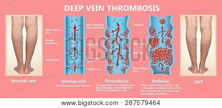 Deep Vein Thrombosis Or Blood Clots. Embolus. Structure Of Normal And Varicose Female Veins