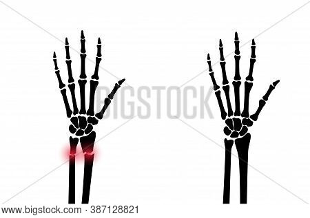 X Ray Of Arm Fracture With Red Pain Points And Normal Arm. Broken Hand With Inner Closed Radius Type