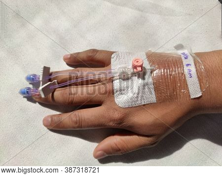 Cannula In Right Arm Of Indian Man Held Down By Tape As A Surgical Aid To Iv Intravenous Drip , Take