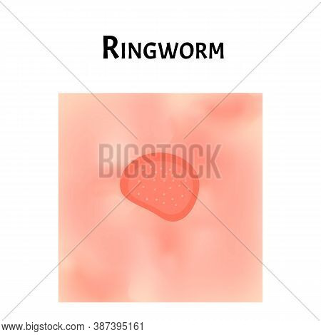 Ringworm On The Skin. Vector Illustration On Isolated Background