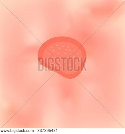 Ringworm On The Skin. Illustration On Isolated Background