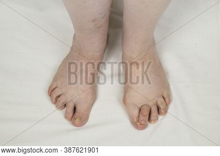 Legs Of An Elderly Woman With Rheumatoid Arthritis. Deformed Rheumatoid Foot