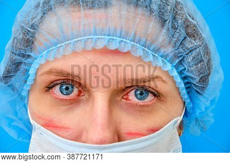 Doctor With Facial Wounds In A Medical Mask, Close-up. A Nurse On A Blue Background With Red Marks F