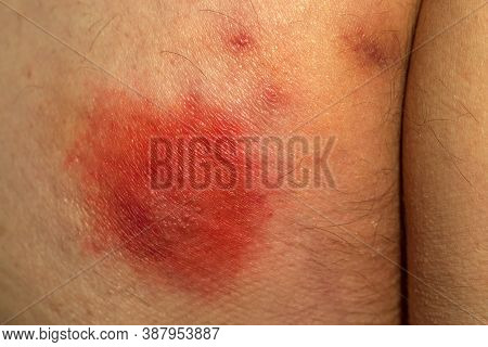 Shingles (disease). Sympton Of The Herpes Virus On The Human Body. Skin Rash And Blisters On The Bod