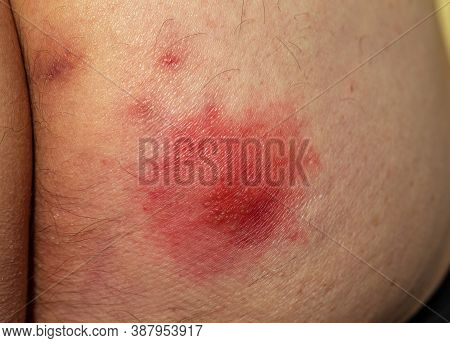 Shingles (disease). Sympton Of The Herpes Virus On The Human Body. Skin Rash And Blisters On The Bod