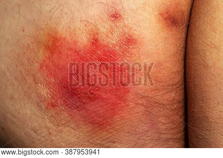 Shingles (disease). Sympton Of The Herpes Virus On The Human Body. Skin Rash And Blisters On The Bod