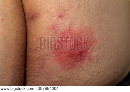 Shingles (disease). Sympton Of The Herpes Virus On The Human Body. Skin Rash And Blisters On The Bod