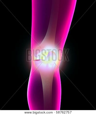 illustration of a painful knee