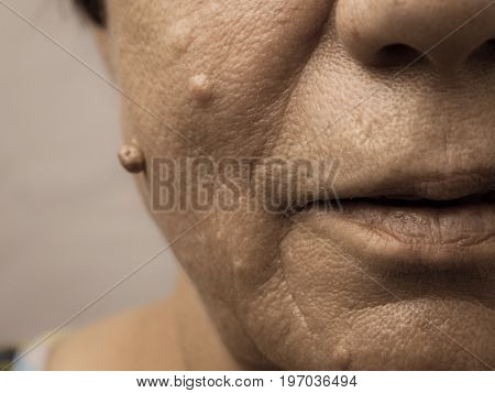 Details of senior woman face. Elderly pensioner female dermal fibroma close up.
