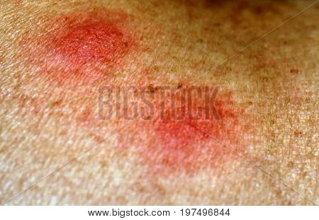 Red mosquito bites. Swelling of the skin. A bite of a wasp, a bee