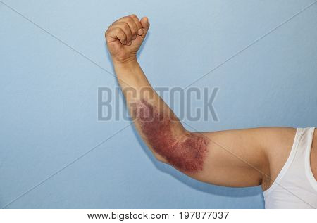 Man With Hematoma