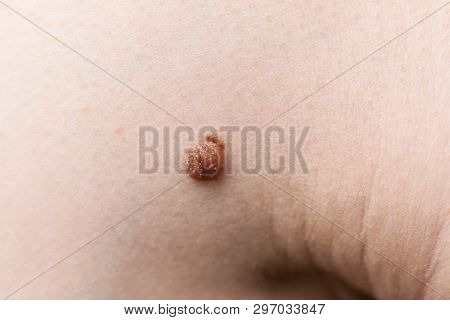 Unrecognizable Person Having Dark Fibroma, Dermatology Problem On Skin. Close Up Of Papilloma Dermat