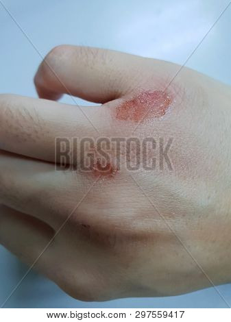 Close Up Of Injuries And Abrasions From Accidents On Hand On White Background, Vertical