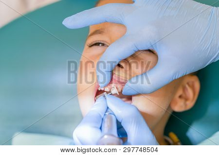 Dentist Is Treating A Boys Teeth. Dentist Examining Boys Teeth In Clinic. A Small Patient In The Den