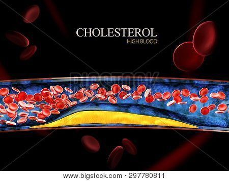 3d Illustration Of Blood Cells With Plaque Buildup Of Cholesterol