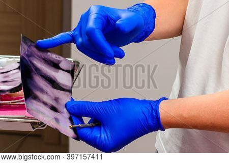 X-ray, The Dentist Holds An X-ray Of The Teeth, Assesses The Integrity Of The Teeth And Nerve Canals