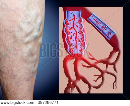 Varicose Veins On A Female Senior Legs. The Structure Of Normal And Varicose Veins. Concept Of Dry S